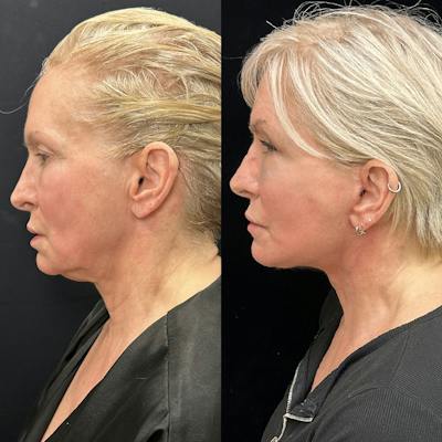 Deep Plane Facelift Before & After Gallery - Patient 664047 - Image 3