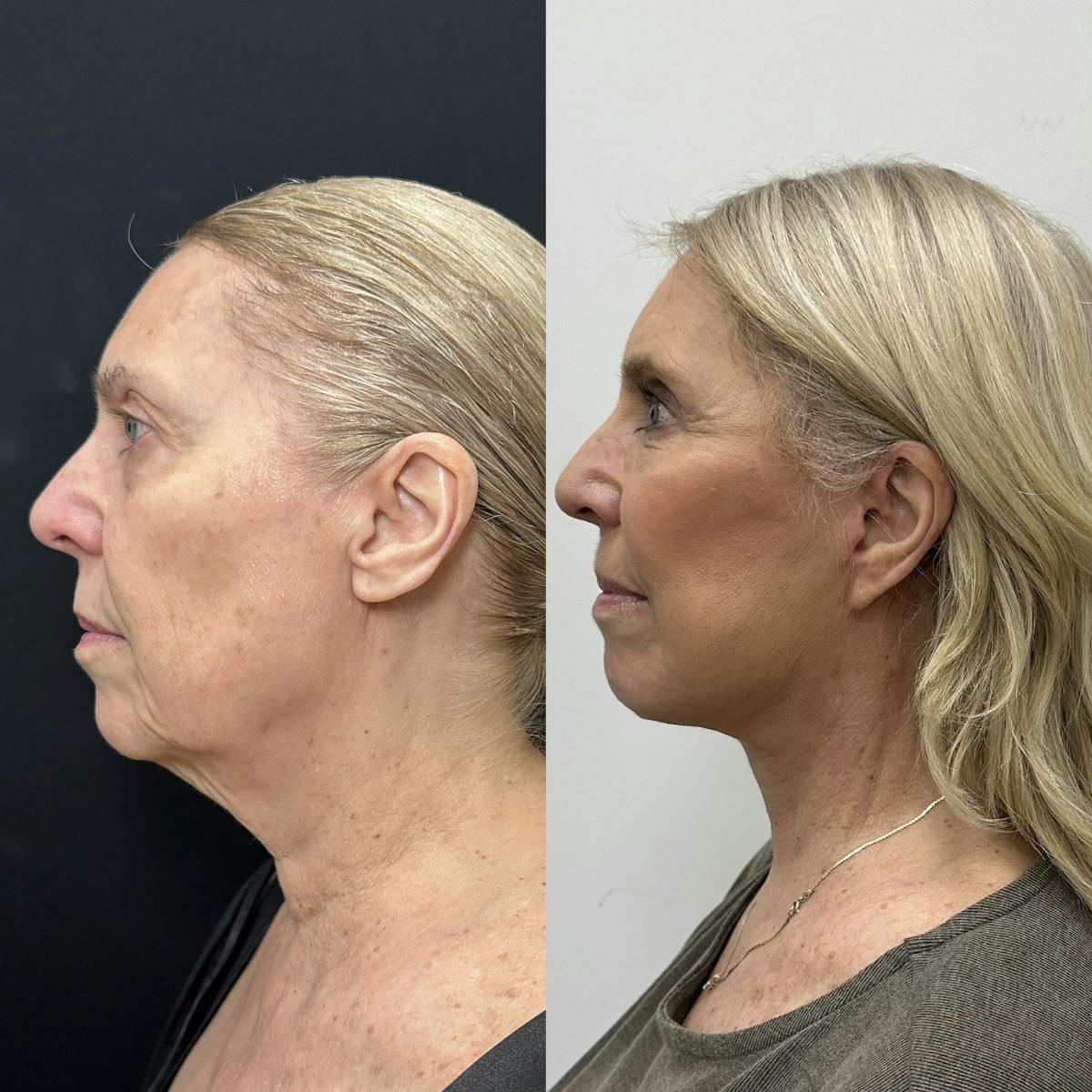 Deep Plane Facelift Before & After Gallery - Patient 100835 - Image 4