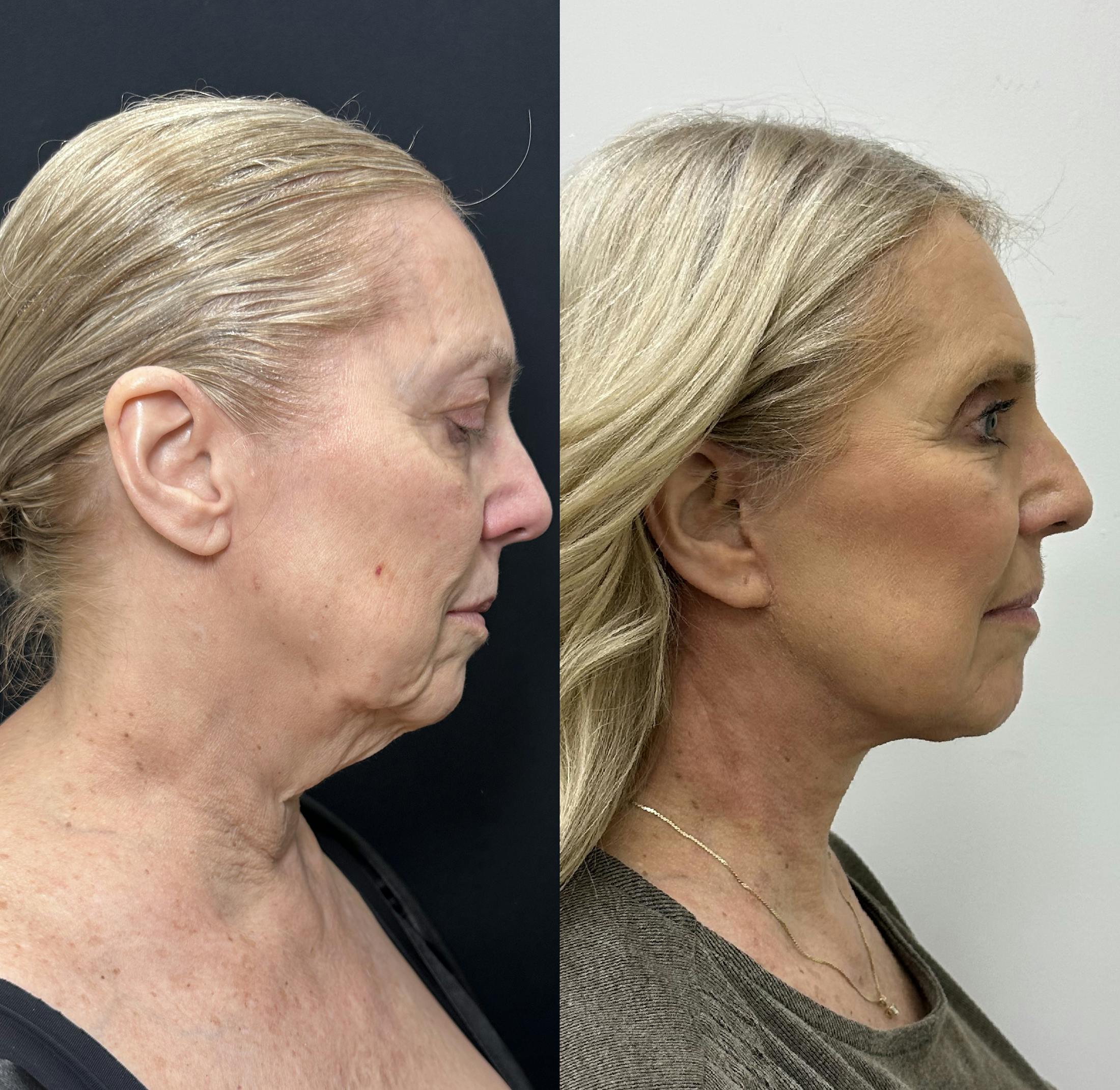 Deep Plane Facelift Before & After Gallery - Patient 100835 - Image 2
