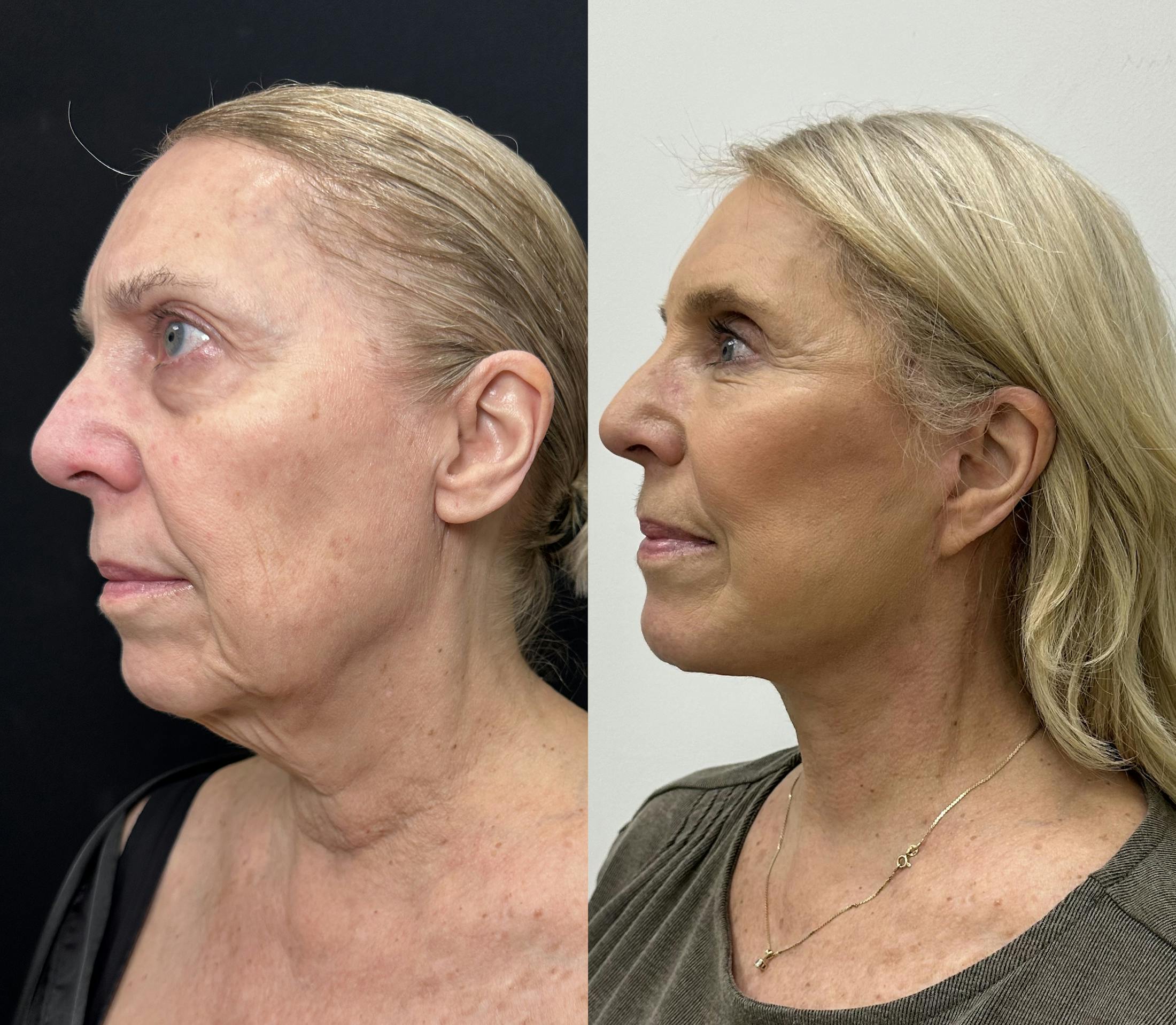 Deep Plane Facelift Before & After Gallery - Patient 100835 - Image 3