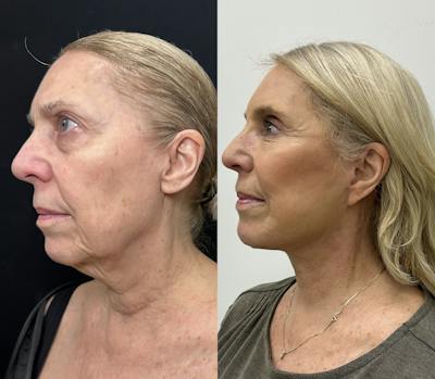 Deep Plane Facelift Before & After Gallery - Patient 100835 - Image 3