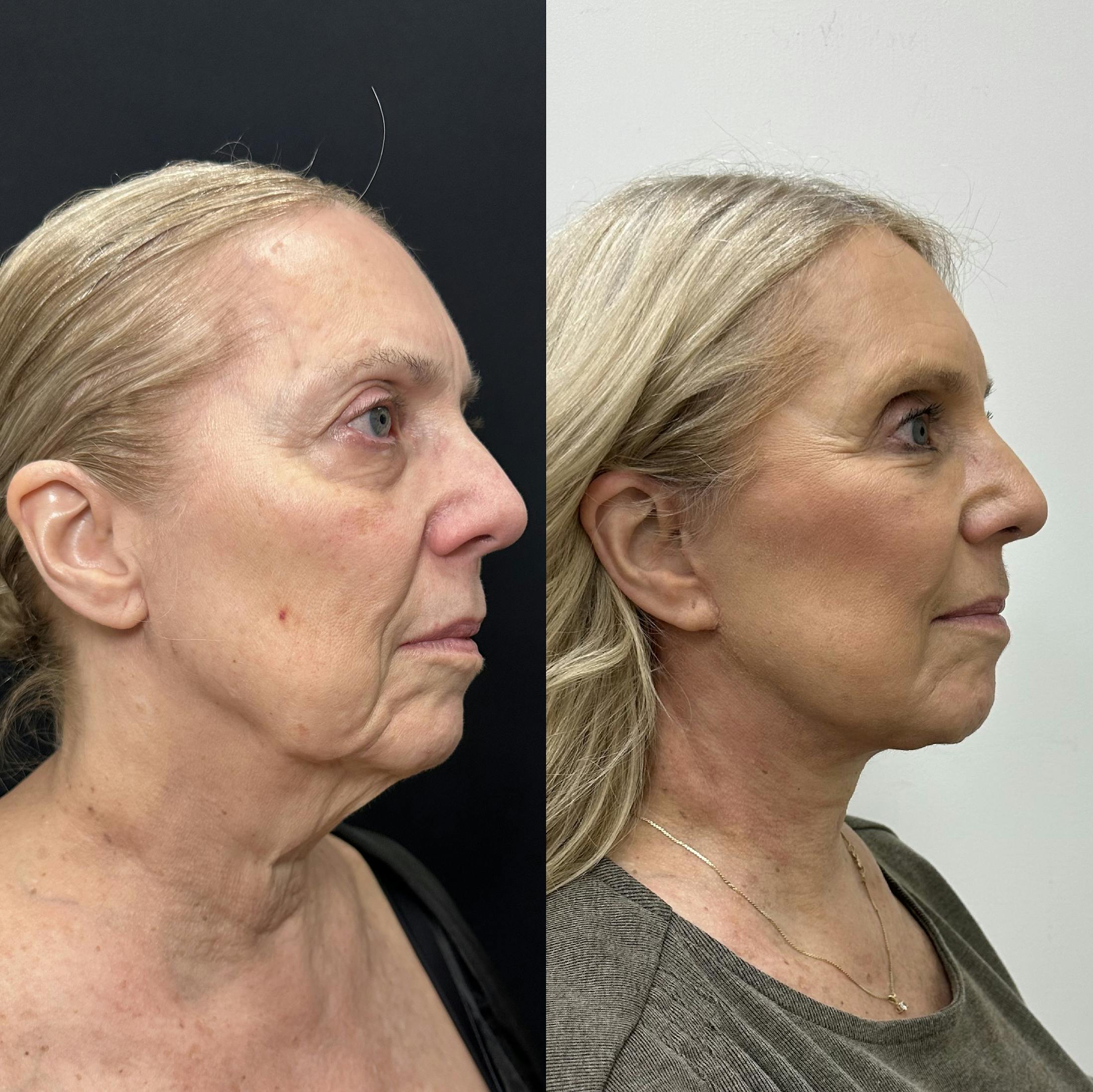 Deep Plane Facelift Before & After Gallery - Patient 100835 - Image 1