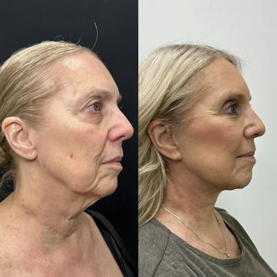 Deep Plane Facelift Before & After Gallery - Patient 100835 - Image 1