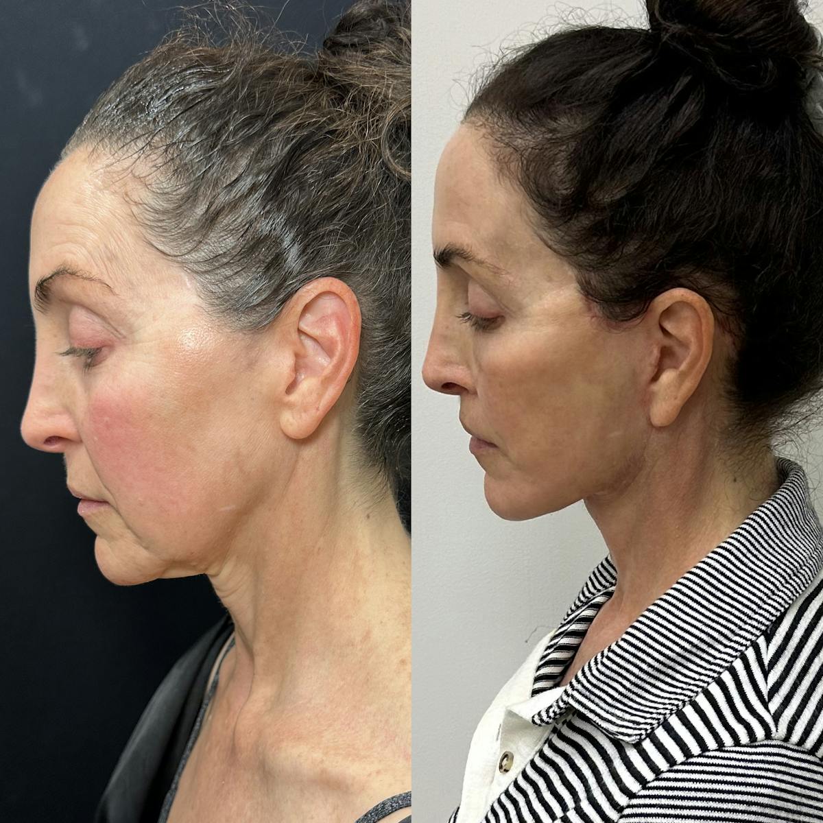 Deep Plane Facelift Before & After Gallery - Patient 296260 - Image 2