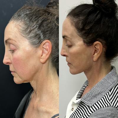 Deep Plane Facelift Before & After Gallery - Patient 296260 - Image 2