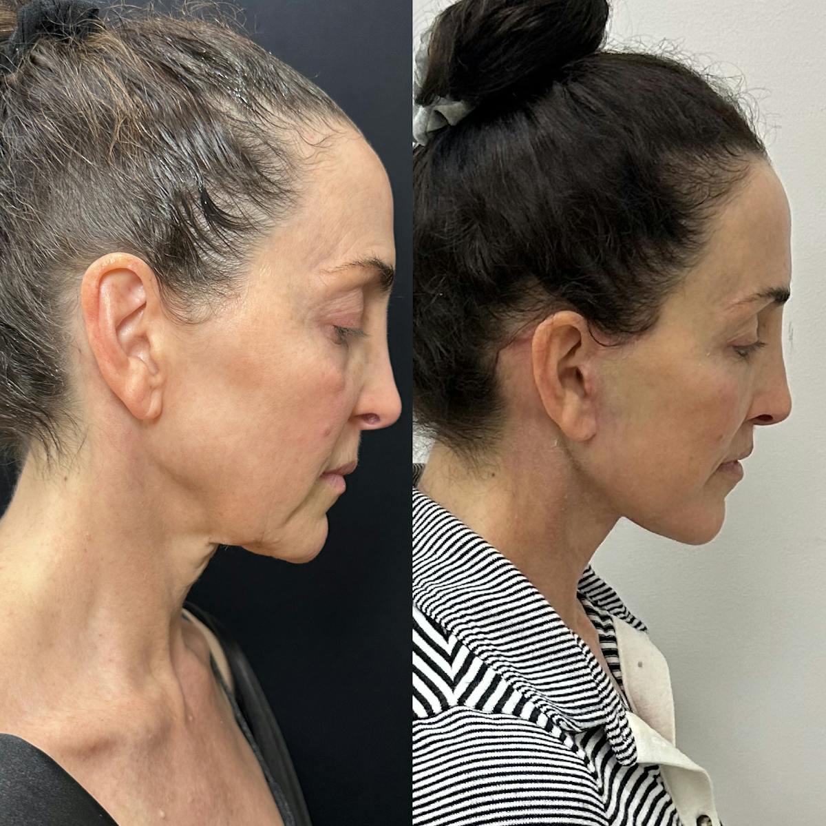Deep Plane Facelift Before & After Gallery - Patient 296260 - Image 1