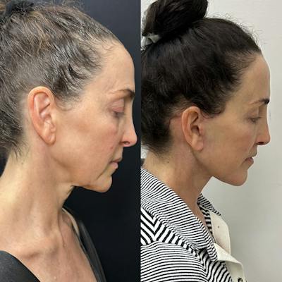Deep Plane Facelift Before & After Gallery - Patient 296260 - Image 1