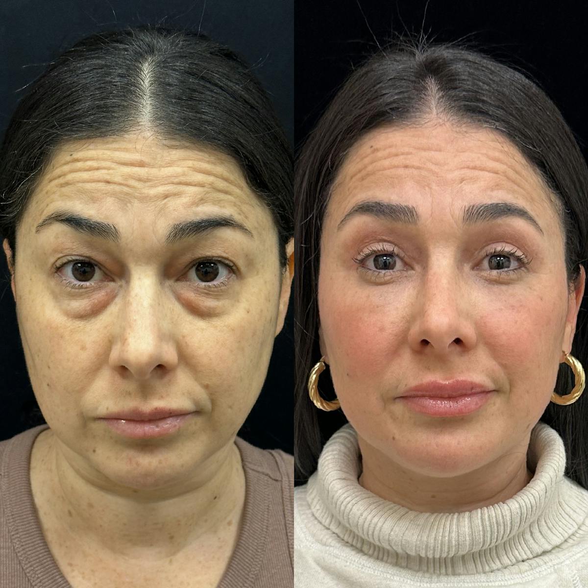  Facial Fat Transfer Before & After Gallery - Patient 310593 - Image 1