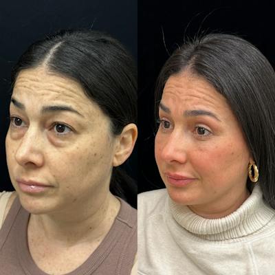 Facial Fat Transfer Before & After Gallery - Patient 310593 - Image 4
