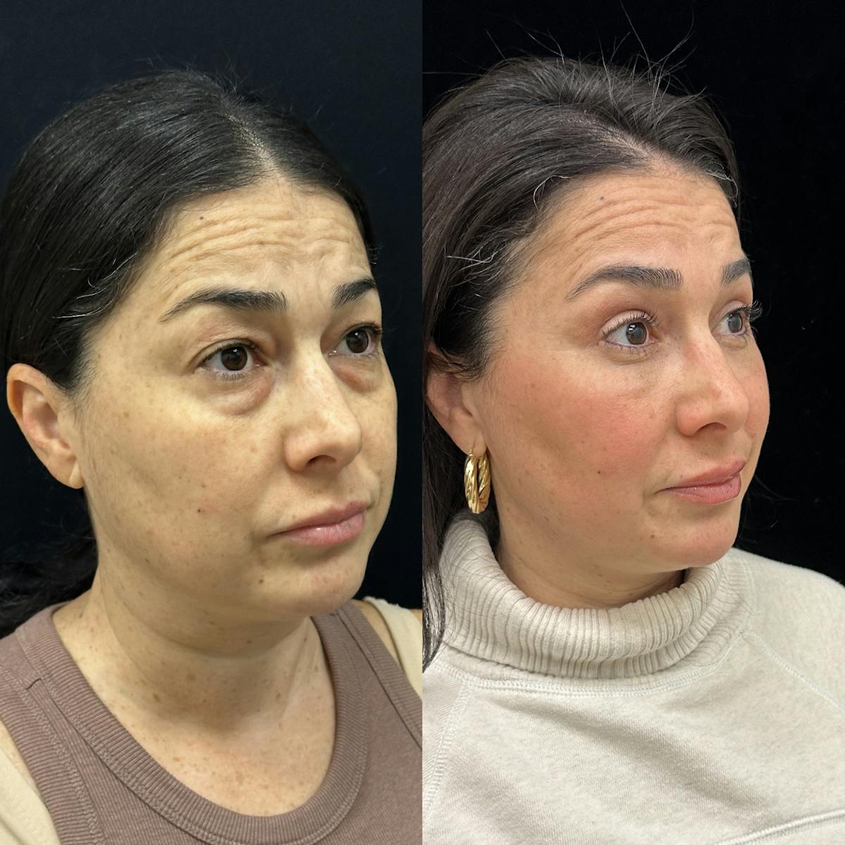  Facial Fat Transfer Before & After Gallery - Patient 310593 - Image 3