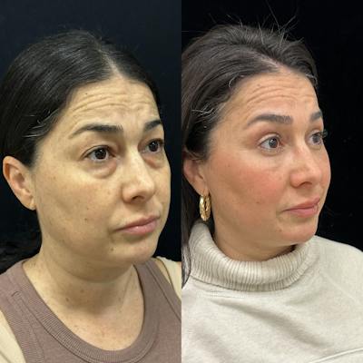 Facial Fat Transfer Before & After Gallery - Patient 310593 - Image 3