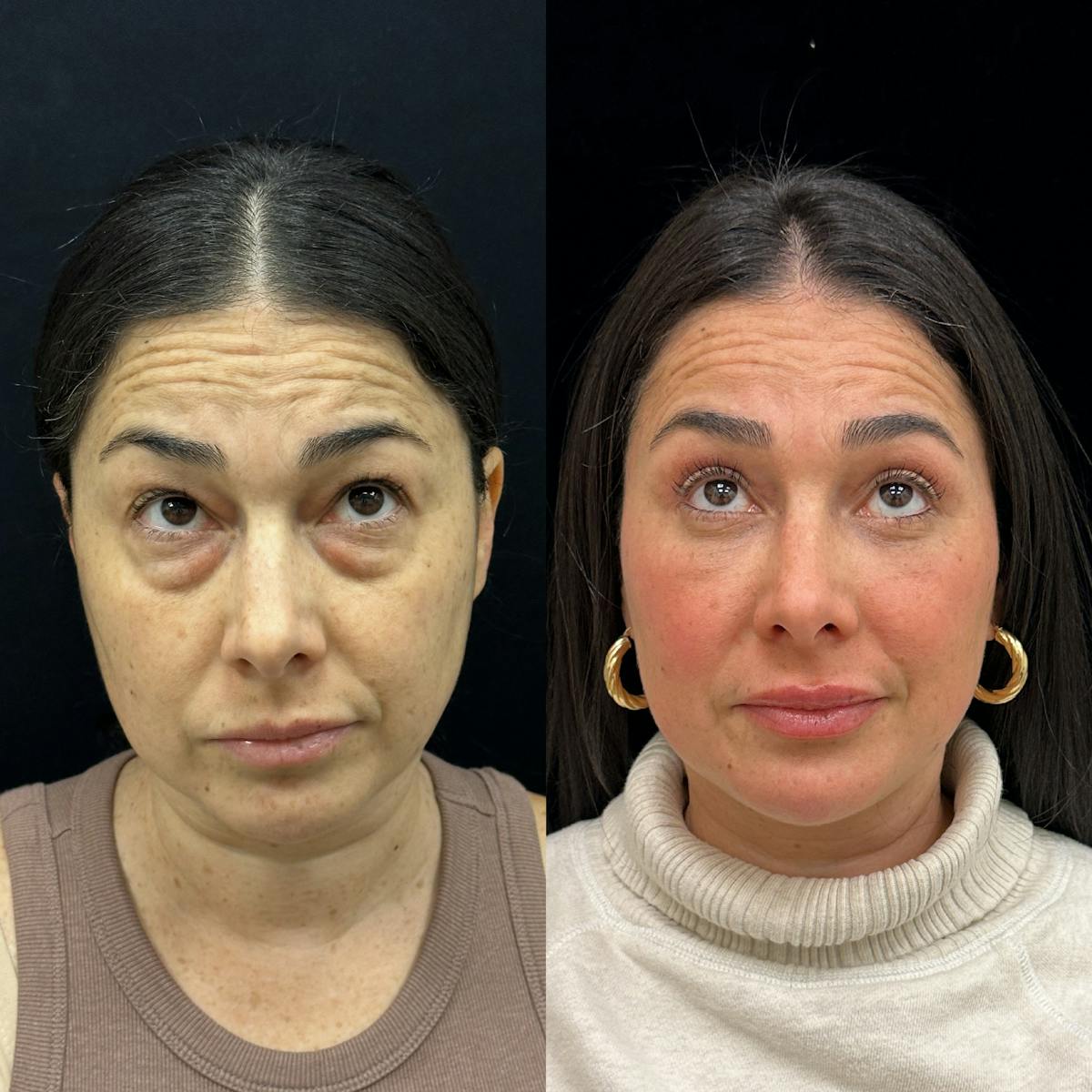  Facial Fat Transfer Before & After Gallery - Patient 310593 - Image 2