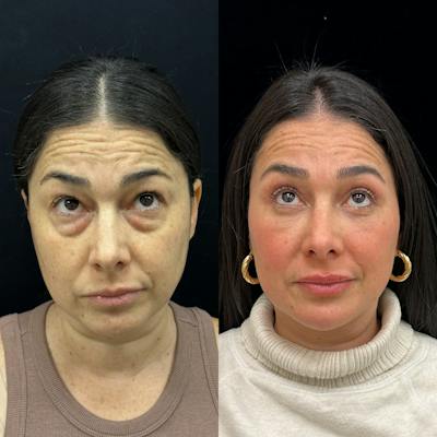Facial Fat Transfer Before & After Gallery - Patient 310593 - Image 2
