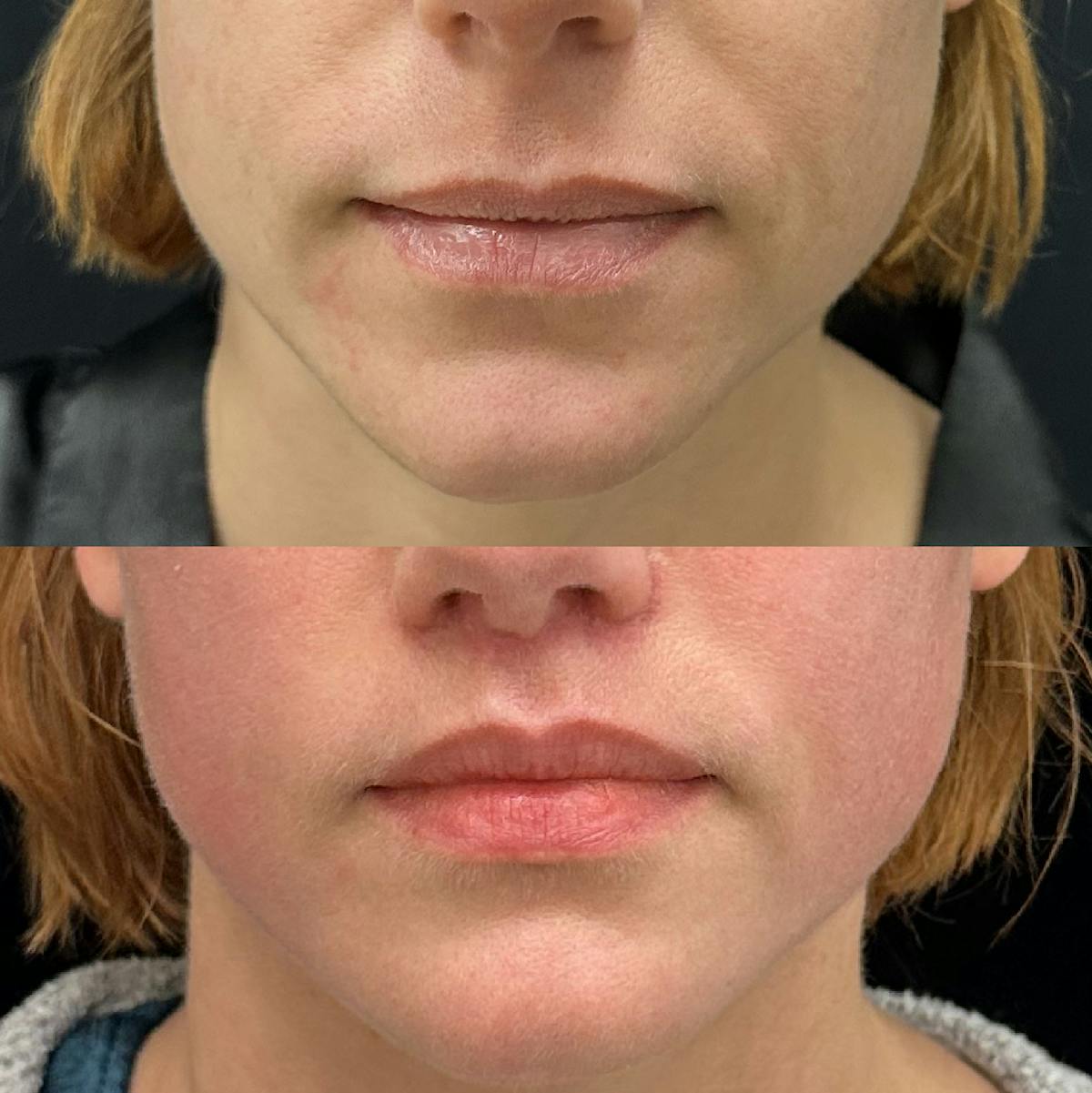 Lip Lift Before & After Gallery - Patient 388742 - Image 1