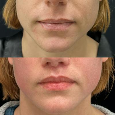 Lip Lift Before & After Gallery - Patient 388742 - Image 1