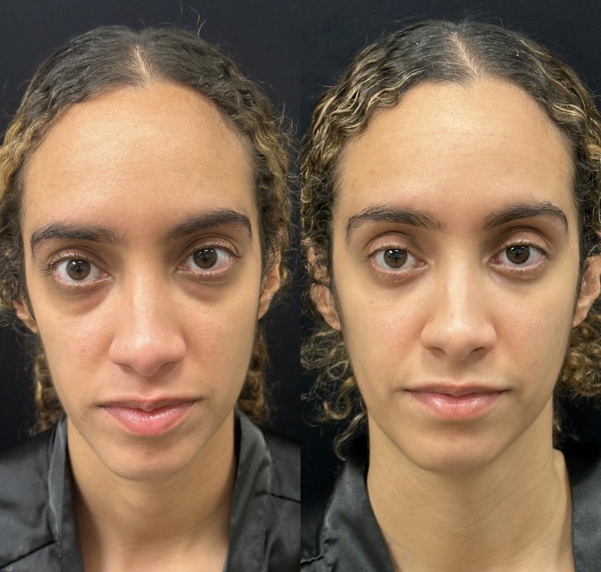 Lower Blepharoplasty Before & After Gallery - Patient 367504 - Image 1