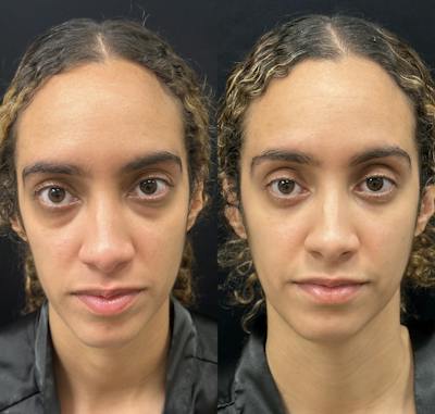 Lower Blepharoplasty Before & After Gallery - Patient 367504 - Image 1