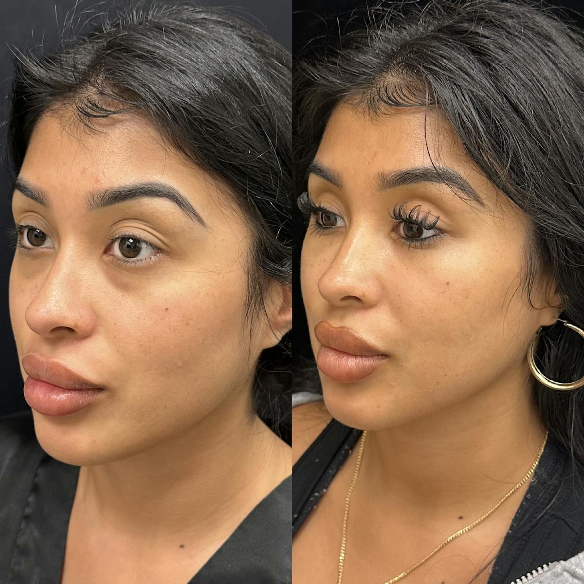 Lower Blepharoplasty Before & After Gallery - Patient 230716 - Image 3
