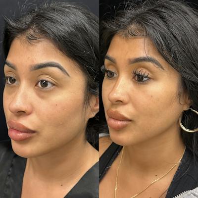 Lower Blepharoplasty Before & After Gallery - Patient 230716 - Image 3