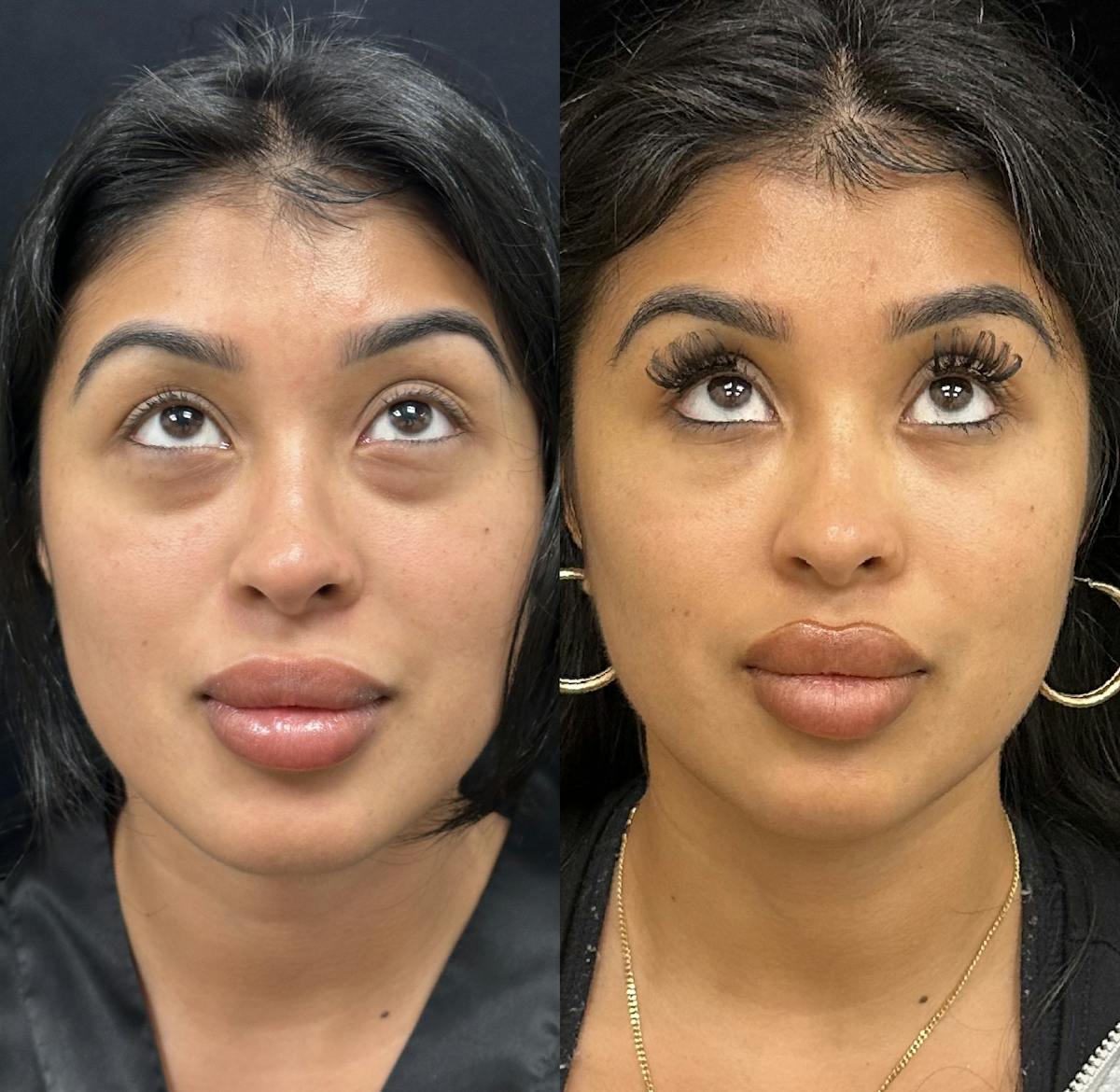 Lower Blepharoplasty Before & After Gallery - Patient 230716 - Image 2
