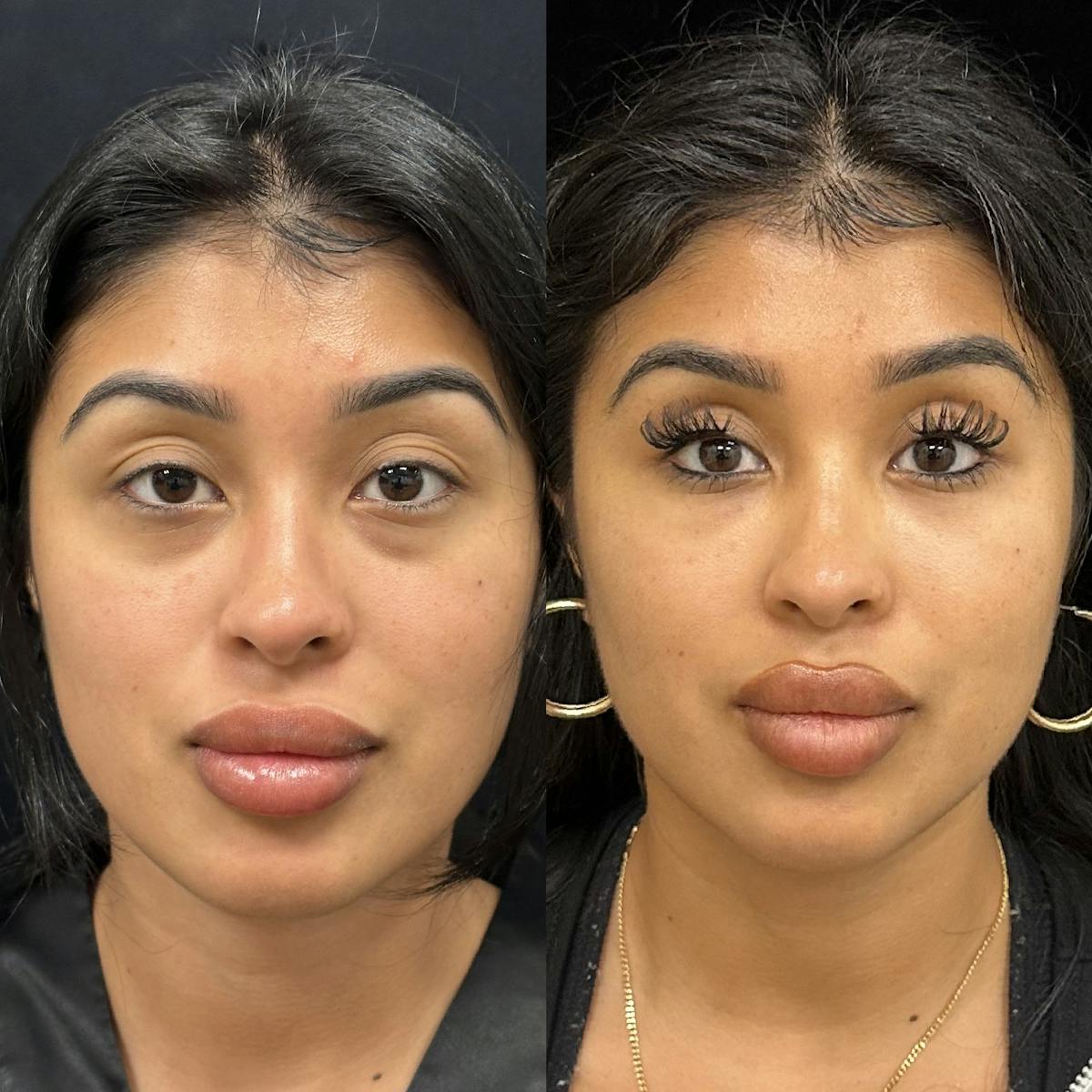Lower Blepharoplasty Before & After Gallery - Patient 230716 - Image 1