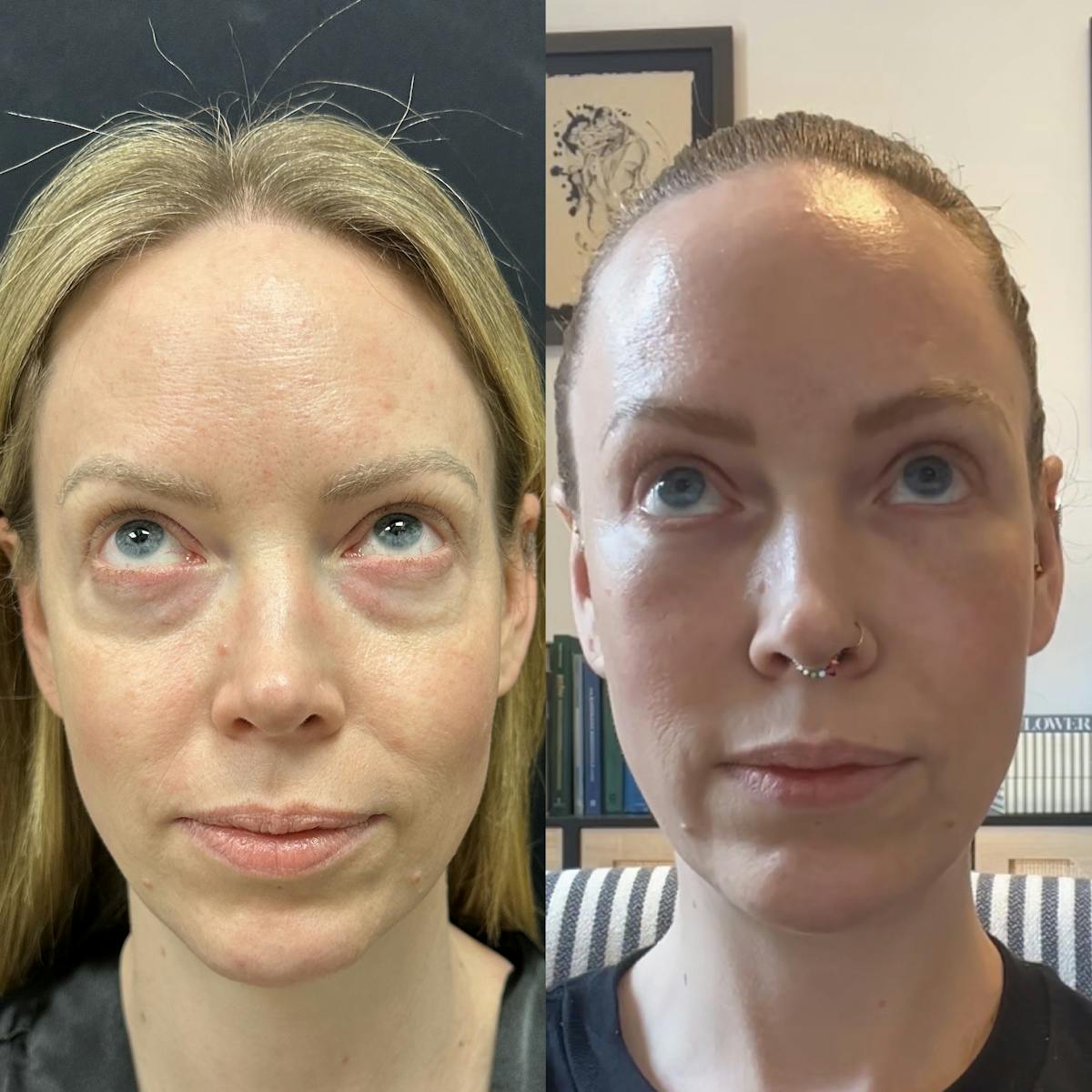 Lower Blepharoplasty Before & After Gallery - Patient 598305 - Image 2