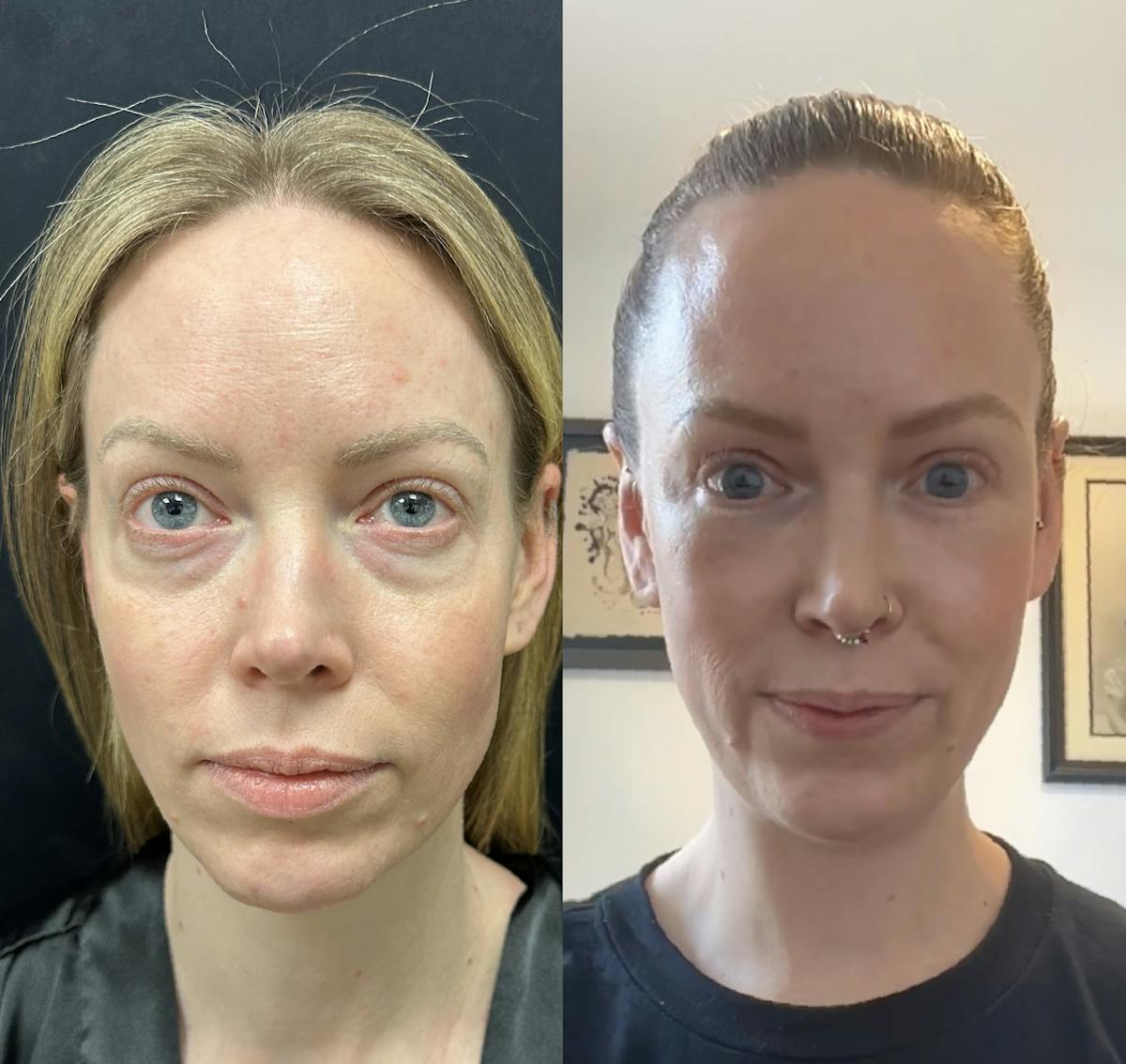 Lower Blepharoplasty Before & After Gallery - Patient 598305 - Image 1