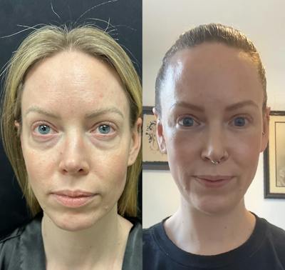 Lower Blepharoplasty Before & After Gallery - Patient 598305 - Image 1