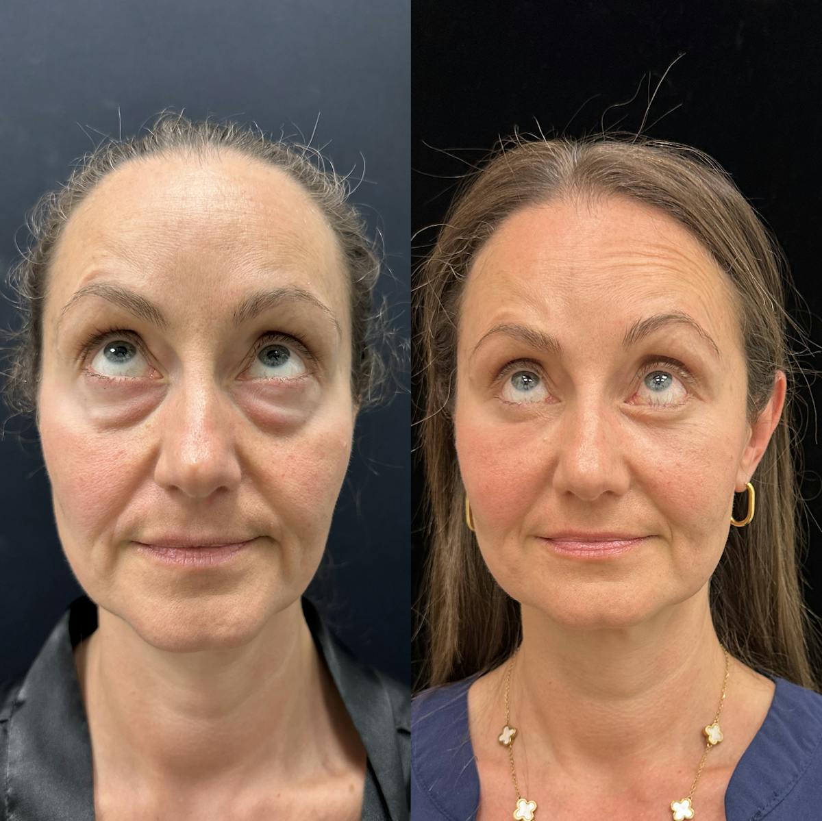 Lower Blepharoplasty Before & After Gallery - Patient 404815 - Image 2