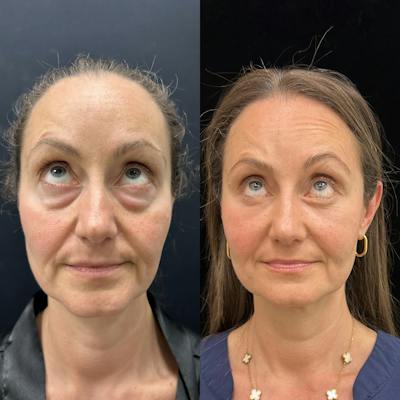 Lower Blepharoplasty Before & After Gallery - Patient 404815 - Image 2
