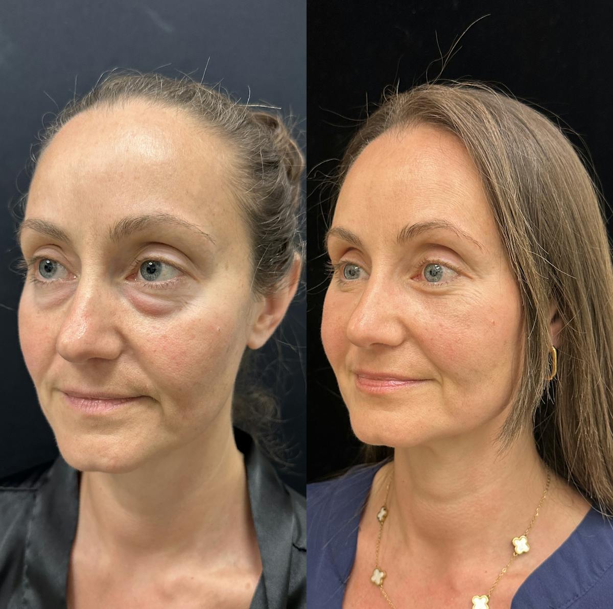 Lower Blepharoplasty Before & After Gallery - Patient 404815 - Image 4