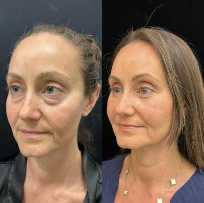 Lower Blepharoplasty Before & After Gallery - Patient 404815 - Image 4