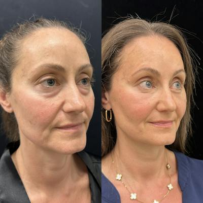 Lower Blepharoplasty Before & After Gallery - Patient 404815 - Image 3