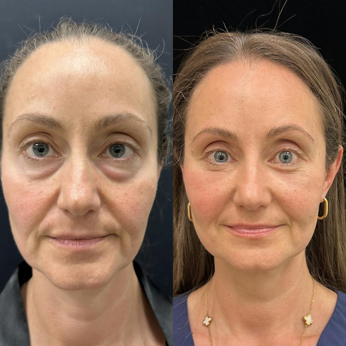 Lower Blepharoplasty Before & After Gallery - Patient 404815 - Image 1