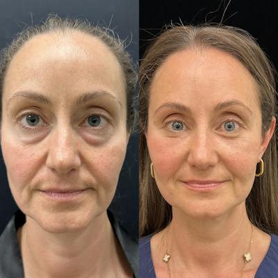 Lower Blepharoplasty Before & After Gallery - Patient 404815 - Image 1