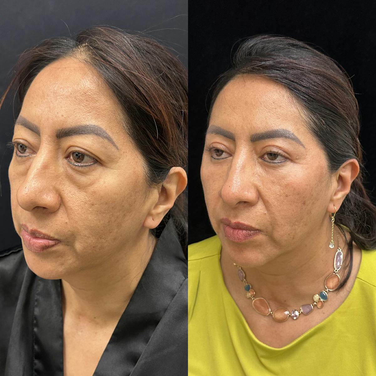 Lower Blepharoplasty Before & After Gallery - Patient 121093 - Image 4