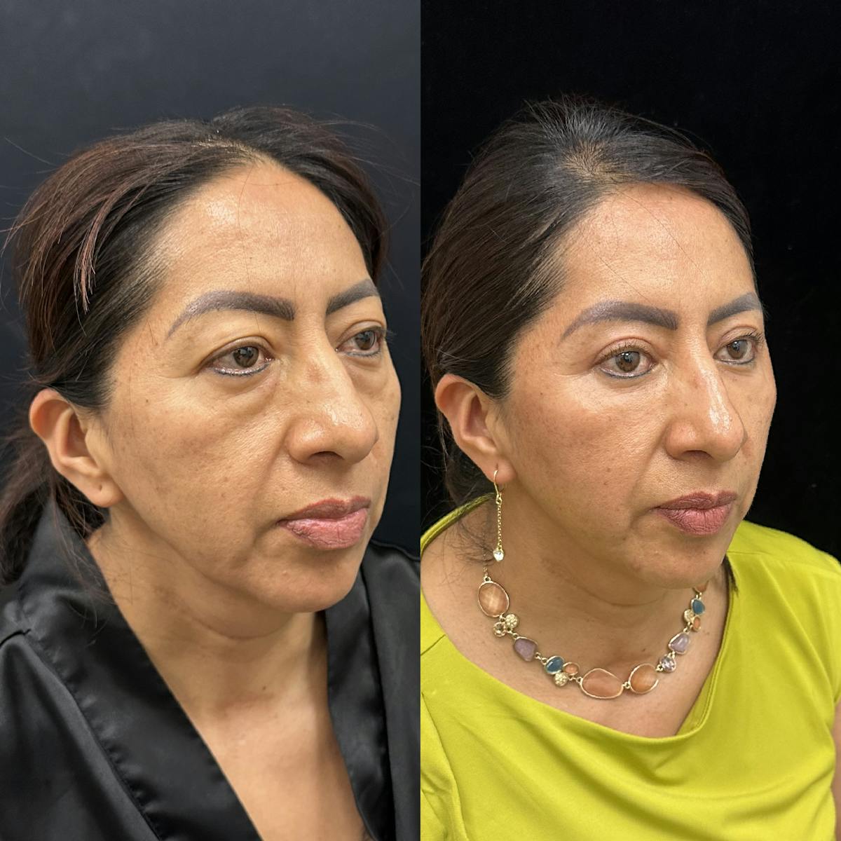 Lower Blepharoplasty Before & After Gallery - Patient 121093 - Image 3