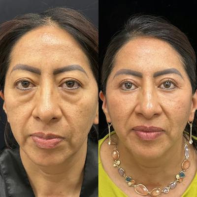 Lower Blepharoplasty Before & After Gallery - Patient 121093 - Image 2