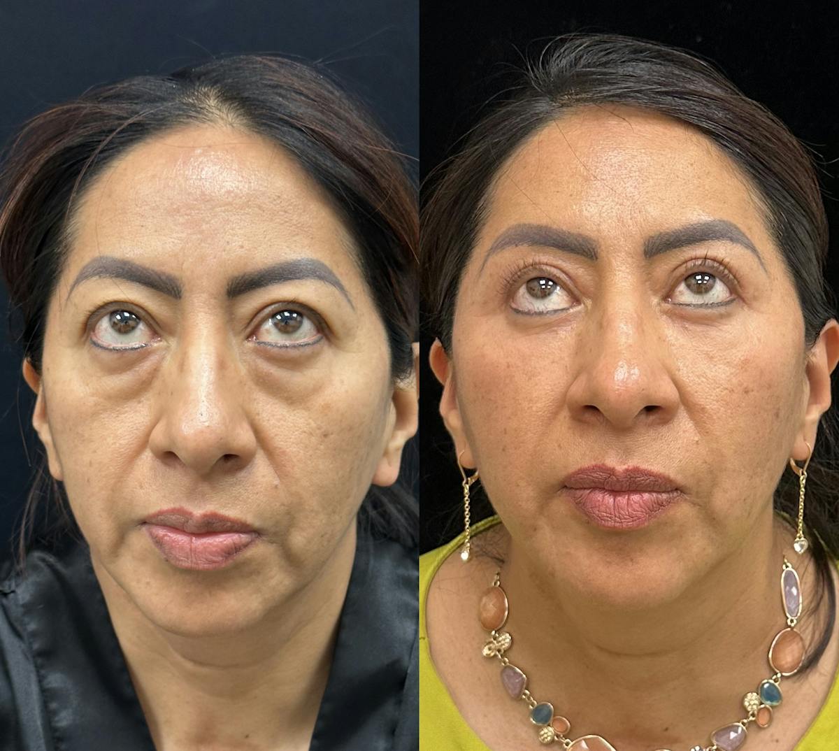 Lower Blepharoplasty Before & After Gallery - Patient 121093 - Image 1