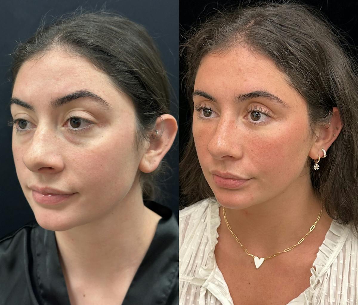 Lower Blepharoplasty Before & After Gallery - Patient 257684 - Image 3