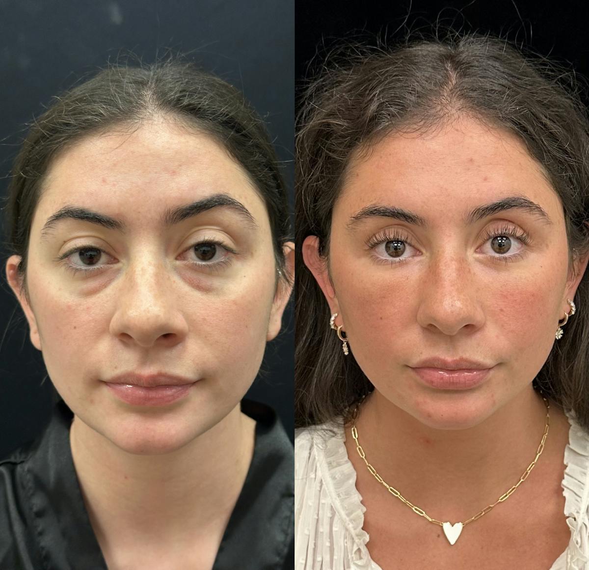 Lower Blepharoplasty Before & After Gallery - Patient 257684 - Image 1