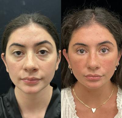 Lower Blepharoplasty Before & After Gallery - Patient 257684 - Image 1