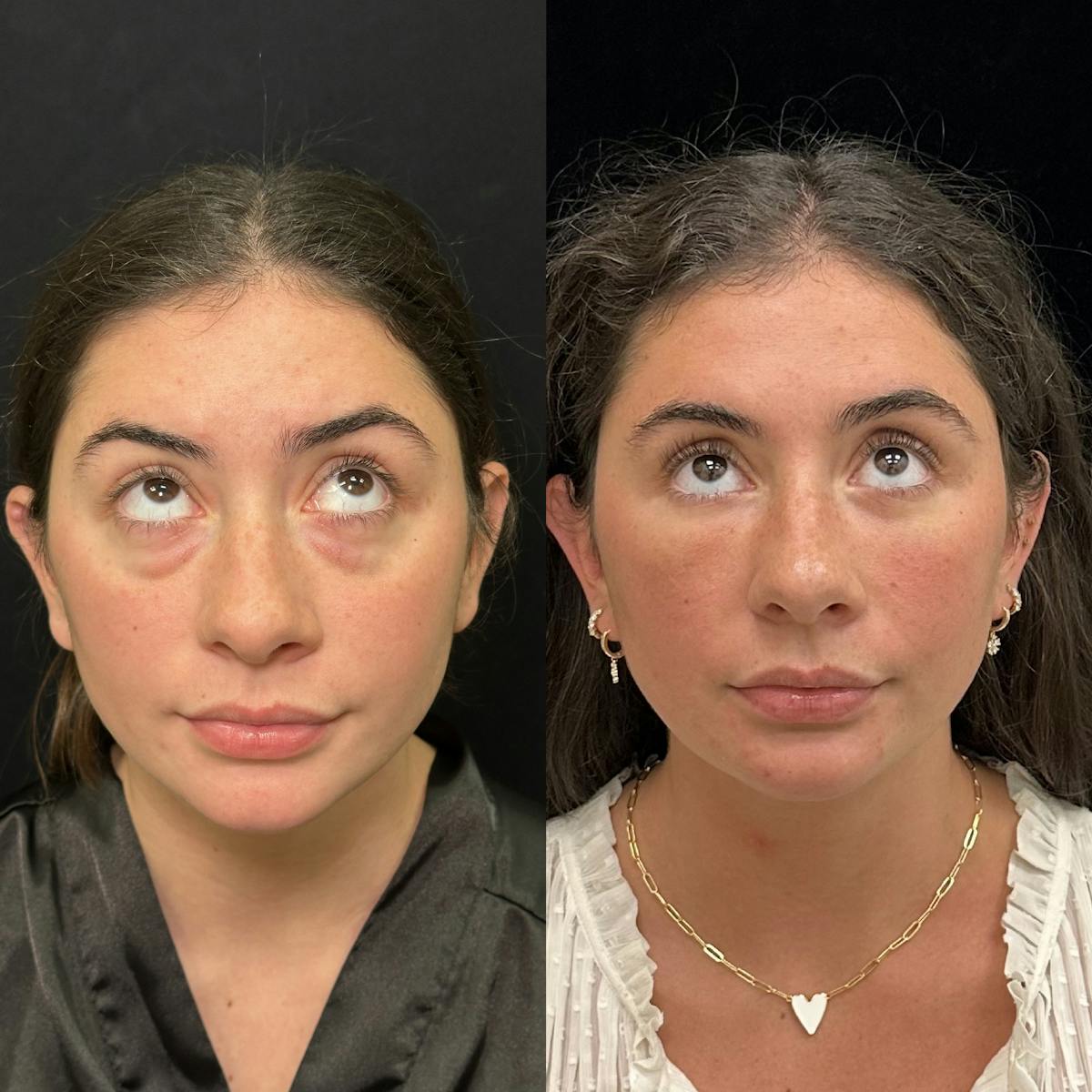 Lower Blepharoplasty Before & After Gallery - Patient 257684 - Image 2