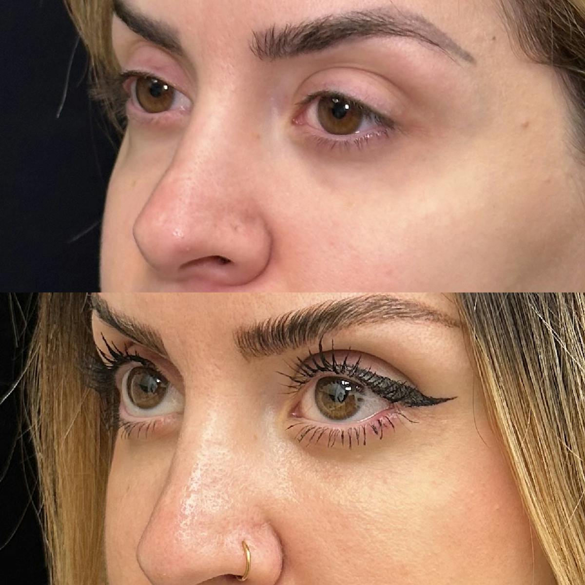 Lower Blepharoplasty Before & After Gallery - Patient 175517 - Image 3