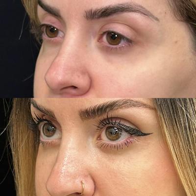Lower Blepharoplasty Before & After Gallery - Patient 175517 - Image 3
