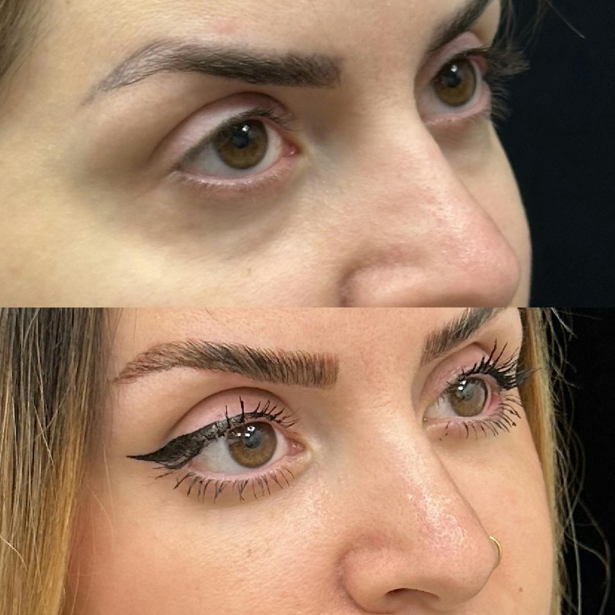 Lower Blepharoplasty Before & After Gallery - Patient 175517 - Image 4
