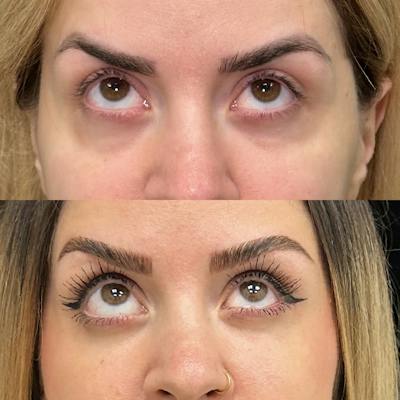 Lower Blepharoplasty Before & After Gallery - Patient 175517 - Image 2