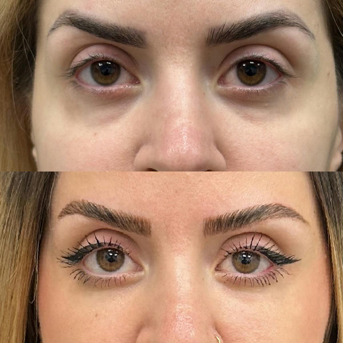 Lower Blepharoplasty Before & After Gallery - Patient 175517 - Image 1