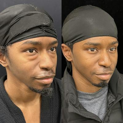 Lower Blepharoplasty Before & After Gallery - Patient 254263 - Image 2