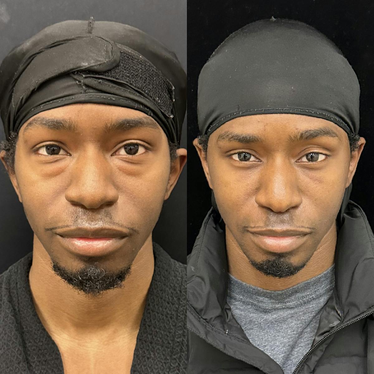 Lower Blepharoplasty Before & After Gallery - Patient 254263 - Image 1